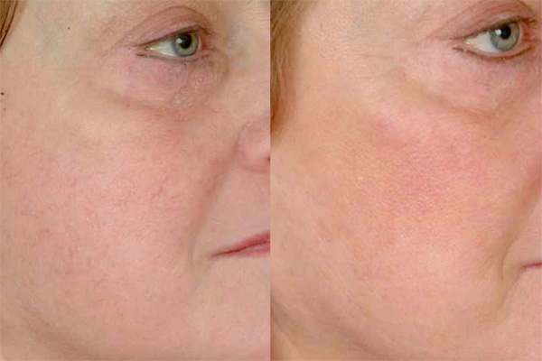 Get your veins removed with laser treatments at  Rejuvi on the West Coast now!