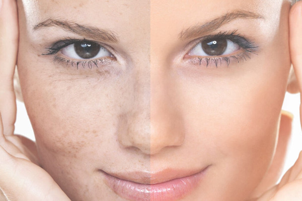 Get your pigmentation laser treated by Rejuvi in Vredenburg today!